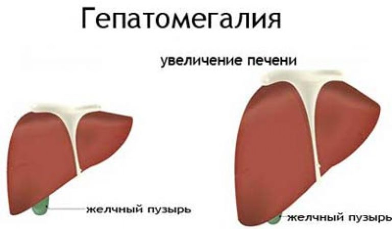 гепатомегалия что это такое